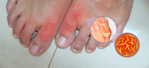 Close-up do dedão do pé inchado e avermelhado, representando uma crise de gota com inflamação intensa na articulação.