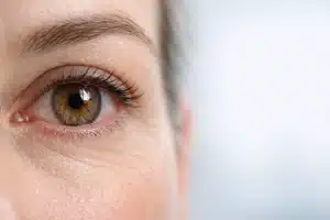 Close-up realista de olho humano com leve vermelhidão (hiperemia conjuntival discreta), íris castanha em foco nítido, iluminação suave de consultório e fundo desfocado em tons claros, representando sintoma ocular associado a condições inflamatórias.